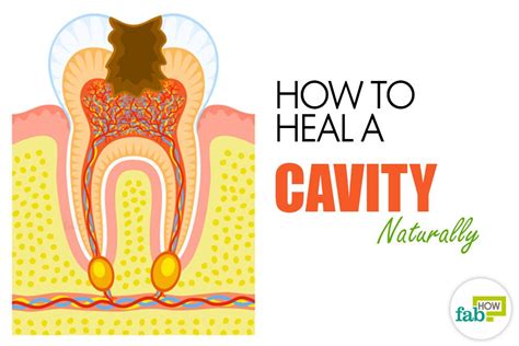 How to Get Rid of Cavities and Heal Tooth Decay | Fab How