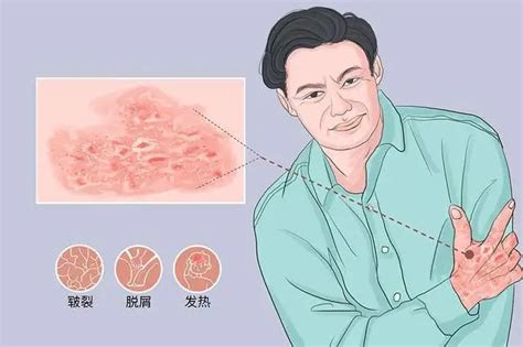 深圳肤康皮肤专科：经常熬夜的鱼鳞病患者应该注意哪些护理事项呢 哔哩哔哩