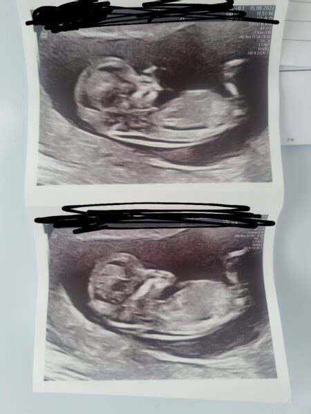 Anyone Guess The Gender Of My Weeks Scan Mumsnet