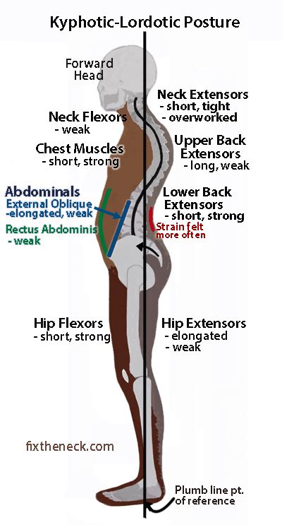 Overcoming Chronic Neck Pain: Postural Causes and A Unique Exercise Fix ...