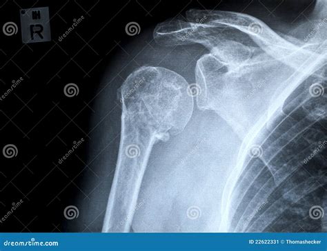 X Ray Fracture Of Acromion Process And Neck Of Humerus Royalty Free