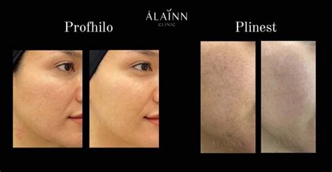 Plinest Treatment In Kuala Lumpur And Petaling Jaya Complete Guide