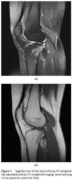 Bone bruise - Physiopedia