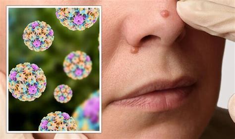 Hpv Symptoms 4 Types Of Wart That Could Mean You Have This ‘very Common Sti Gp Says Express