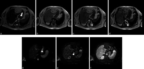 Mri Scans In A Patient With Liver Lipoma A Axial T 2 Weighted Image