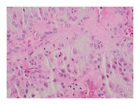 Tumor Cells Have Occasionally Prominent Nucleoli And Eosinophilic To