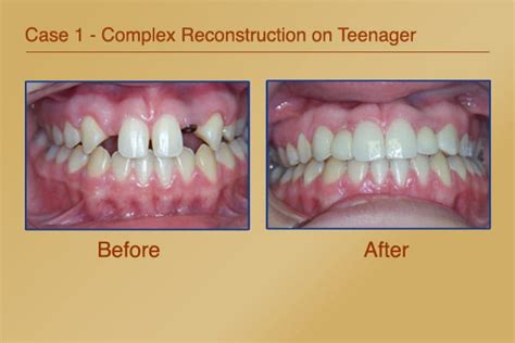 Dental Crowns Before And After