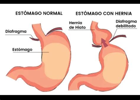 Tipos De Hernia De Hiato