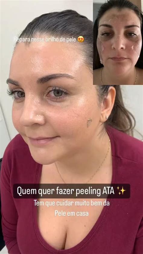 Peeling De Ata V Deo Peeling Facial Est Tica Facial Pele