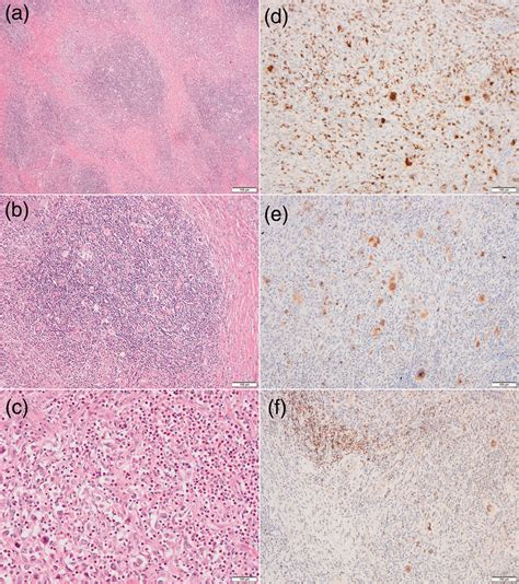 Diagnostic Challenge Of Soft Tissue Extranodal Hodgkin Lymphoma In Core Needle Biopsy Case