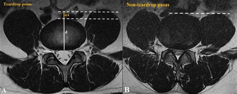 Comparison Of The Teardrop Psoas A And No Teardrop Psoas B A