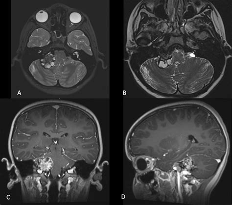 Preoperative MRI showing a right jugular foramen heterogenous mass with ...