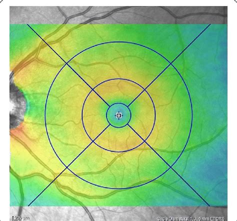 Thickness Map Of The 30 25 OCT Cube The ETDRS Grid Was Centered On