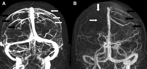 Angiography Brain