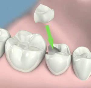 Incrustaciones Dentista En Madrid Centro Cl Nica Dental Odontal