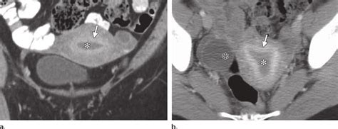 Type Thick Subendometrial Enhancement In A Year Old Woman With