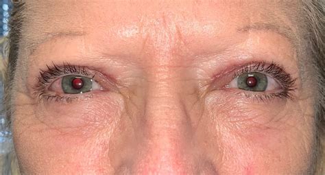 16 Upper Eyelid Surgery Before And After Photos Dallas Plano Texas Cosmetic Reconstructive