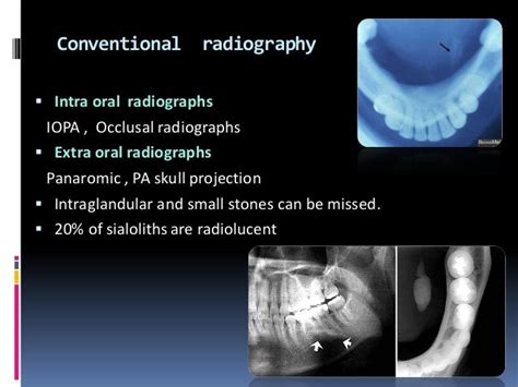 Sialolithiasis and its management in oral and maxillofacial surgery