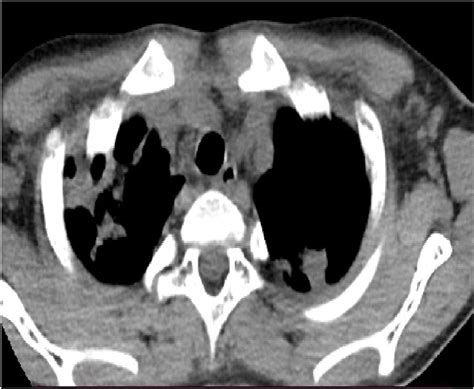 Axial Ct Of The Chest Mediastinal Window Showing Bilateral Pulmonary