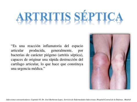 Artritis Septica José Luis Pérez Camacho uDocz