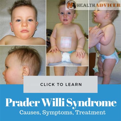 Prader Willi Syndrome: Causes, Picture, Symptoms, Treatment