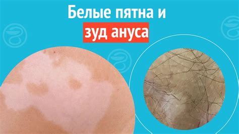 🙄 Белые пятна и зуд ануса. Клинический случай №1317 - YouTube