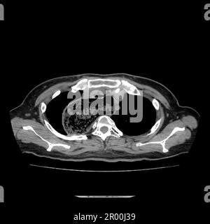 Achalasia of the oesophagus, CT scan Stock Photo - Alamy