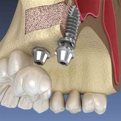 Sinus Lifts Bone Graft In Tijuana BioDental Care Mexico