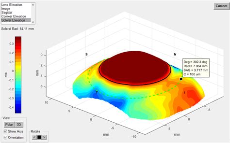 SMap3D Designed Scleral Lenses Sydney Westmead Eyes Optometrists