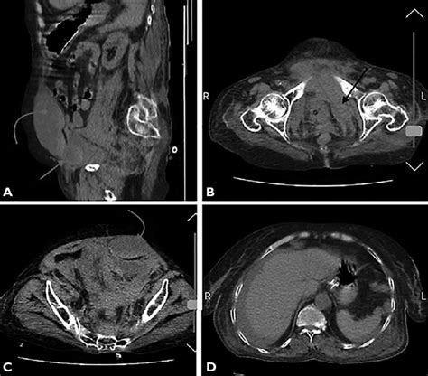 Abdominalpelvic Computed Tomography Scan Without Contrast Showing Download Scientific Diagram