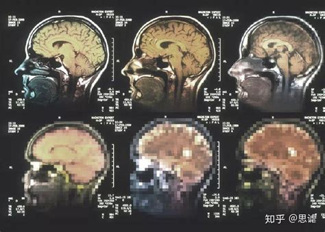 了解阿尔茨海默症的6个发展阶段 知乎