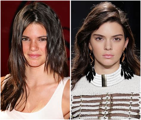 Acne "Completely Ruined" Kendall Jenner's Self-Esteem - Life & Style