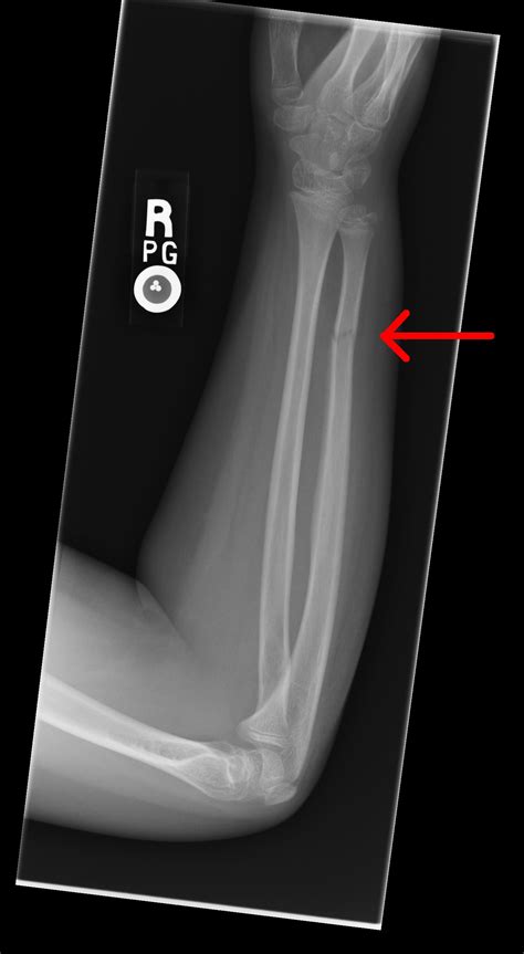 Greenstick Fracture Radiology