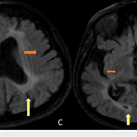 C D Axial Flair Brain Mris Demonstrate Diffuse Hyperintensities In The Download Scientific