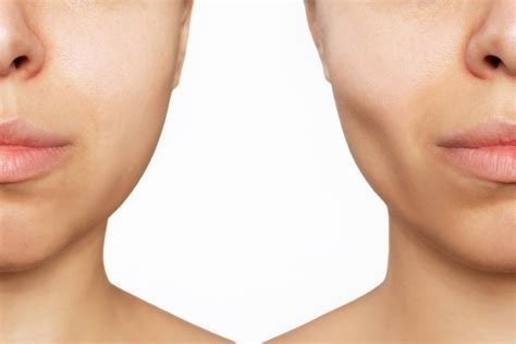 Buccal Fat Removal Cost In Us Effective Results