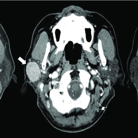 Graphs Show A Comparison Of The Mavs Of Parotid Gland Tumors On The