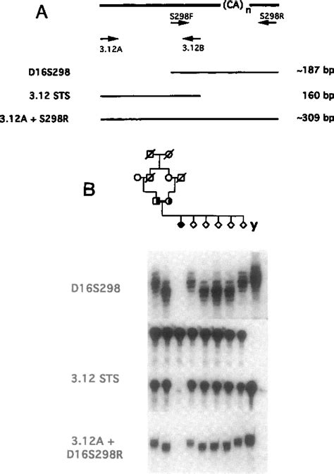 Figure 3 from Chromosome 16 microdeletion in a patient with juvenile ...