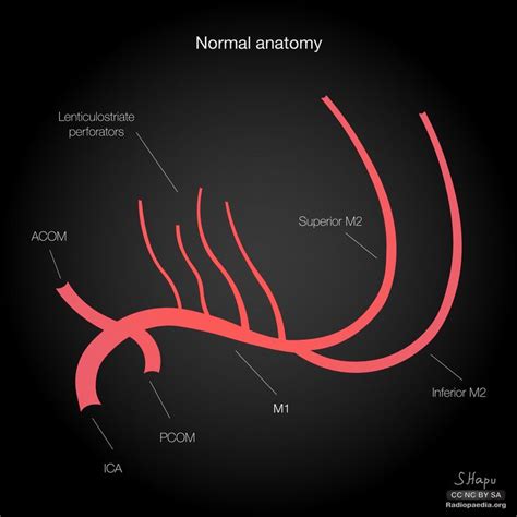 Middle cerebral artery variants: diagrams | Radiology Case ...