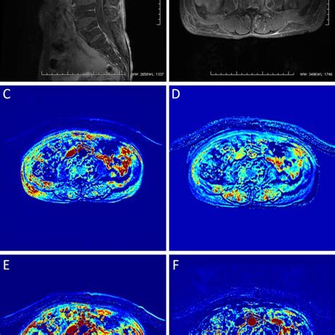 T Weighted Dynamic Contrast Enhanced Magnetic Resonance Imaging