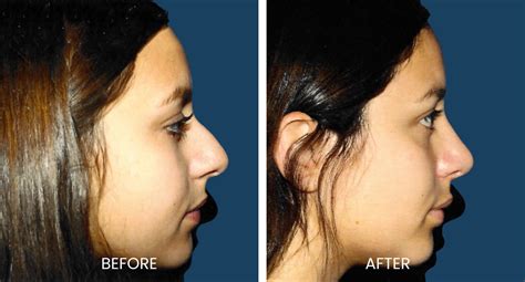 Complete Rhinoplasty Recovery Timeline and Breakdown