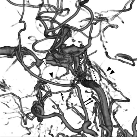 Illustration Of The Arterial Anatomy Of The Right Parasellar Area In