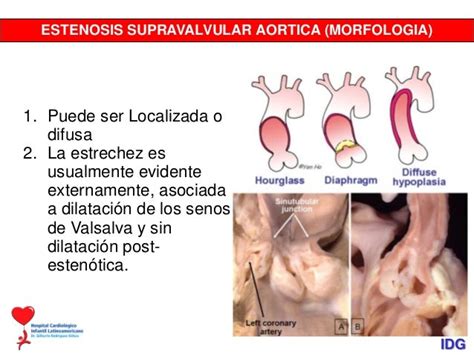 Estenosis Supravalvular Aórtica