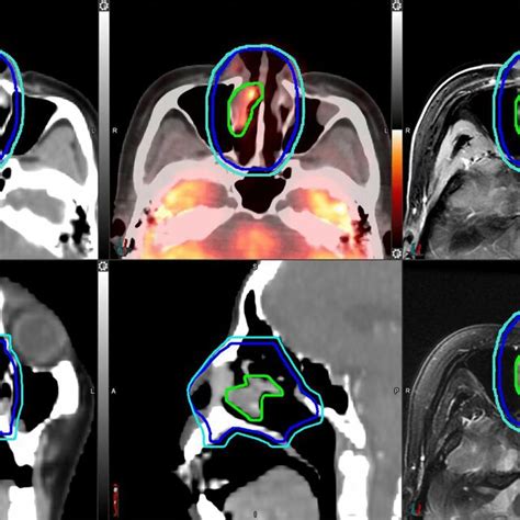 An Example Of Target Delineation In A Patient With Localized Stage I