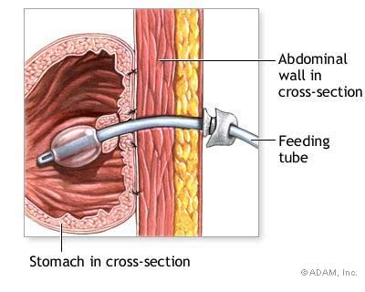 The New York Times > Health > Slide Show > Gastrostomy Tube Placement ...