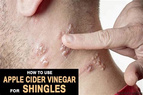 How To Cure Shingles With Apple Cider Venigar Apple Cider Vinegar Remedies Apple Cider