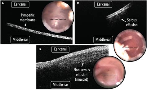 Otitis Media With Effusion Otoscope