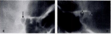 Tomograms of the optic canal of the same case as in Figure 6. (A ...