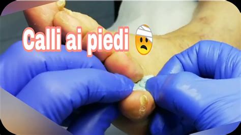 Calli Dolorosi Tra Le Dita Del Piede Scarico Posturale Guarda Come