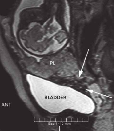 Magnetic Resonance Imaging Of Placenta Percreta Bladder Invasion Ant Download Scientific