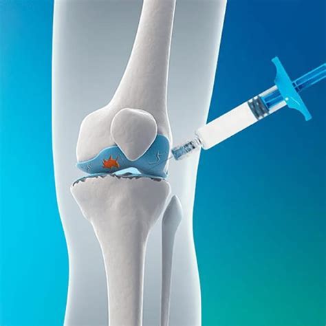 Viscosupplementation Melbourne Arthritic Knee Treatment